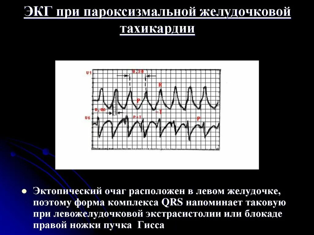 Желудочковая тахикардия на экг. Пароксизм желудочковой тахикардии ЭКГ. Пароксизмальная желудочковая тахикардия на ЭКГ. Желудочковая форма пароксизмальной тахикардии на ЭКГ. Эктопический очаг ЭКГ.