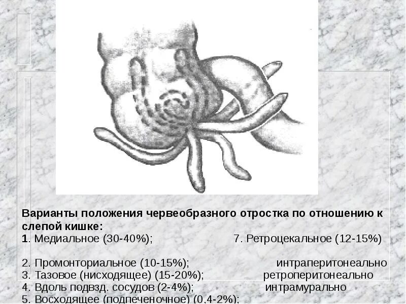 Размер аппендикса. Локализация аппендикса анатомия. Острый аппендицит локализации отростка. Ретроцекальный аппендицит. Типы расположения аппендикса.