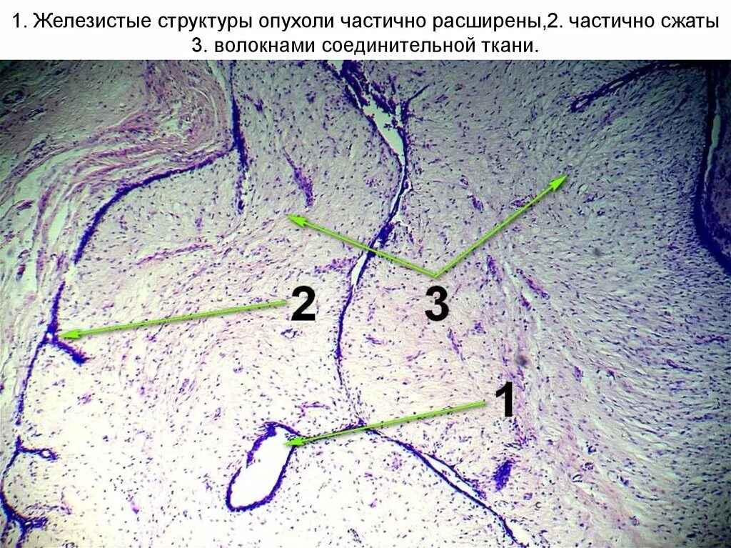 Опухоли волокнистой соединительной ткани. Злокачественная опухоль из волокнистой соединительной ткани. Доброкачественная опухоль из волокнистой соединительной ткани. Опухоль железистой ткани. Злокачественная опухоль из соединительной