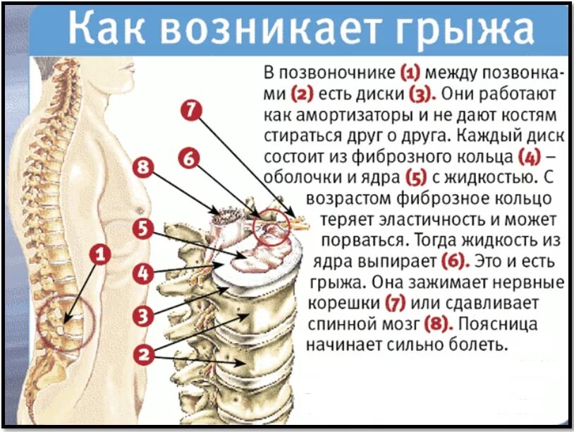 Грыжа поясничного отдела лечение у мужчин симптомы. Грыжа диск спинальный. Причины появления грыжи позвоночника в поясничном отделе. Грыжа дисков позвоночника что это такое. Грыжа диска позвоночника поясничного отдела.