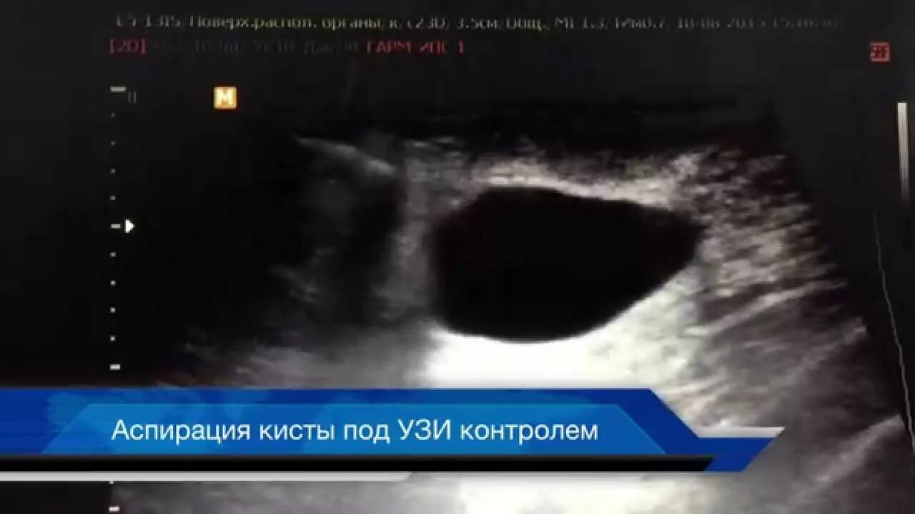 Склерозированная киста молочной железы. Пунктировать кисту молочной. Аспирация кисты молочной железы. Склеротизация кисты молочной железы