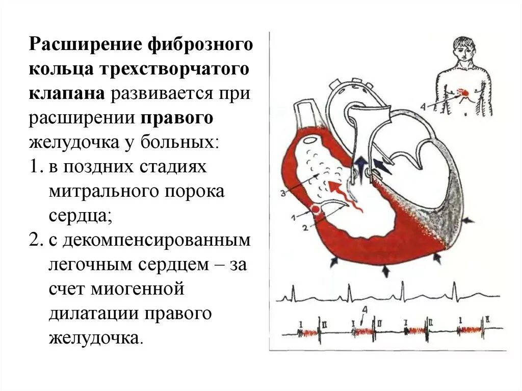 Расширение фиброзного кольца митрального клапана. Трикуспидальный клапан фиброзное кольцо норма. Фиброзное кольцо митрального клапана. Фиброзное кольцо митрального клапана норма.