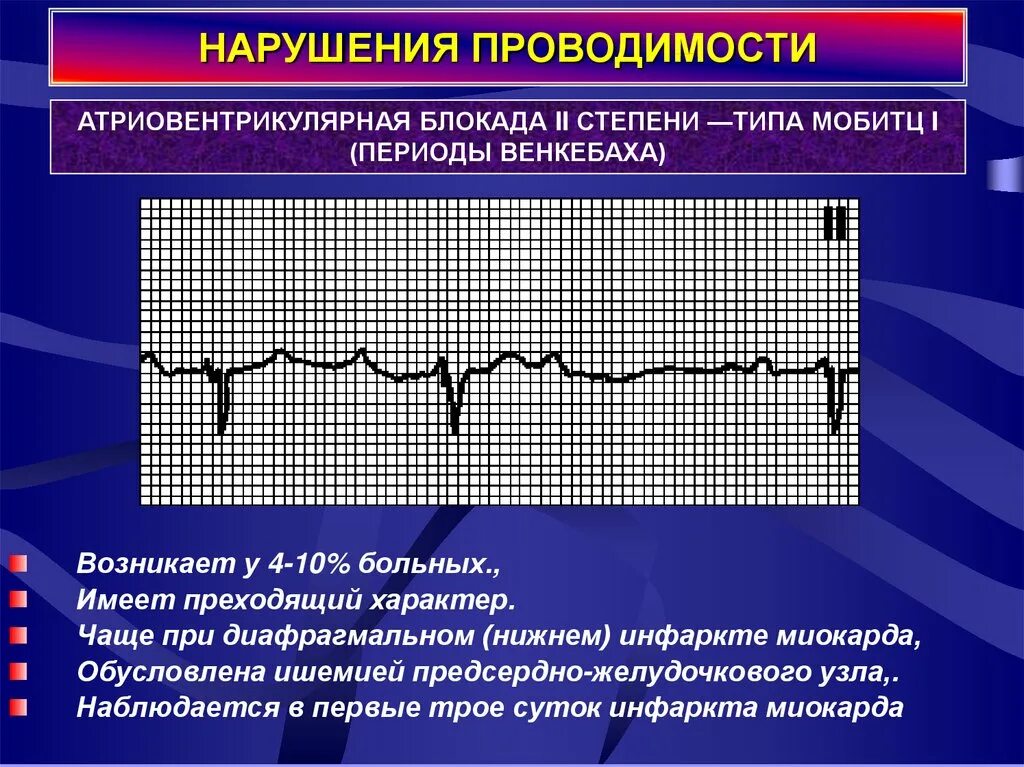 Блокада заболевание. Атриовентрикулярная блокада Мобитц 1. Нарушение атриовентрикулярной проводимости на ЭКГ. АВ-блокада 2 степени Мобитц 1 Тип 2:1. Блокада 2 степени сердца 1 Мобитц.