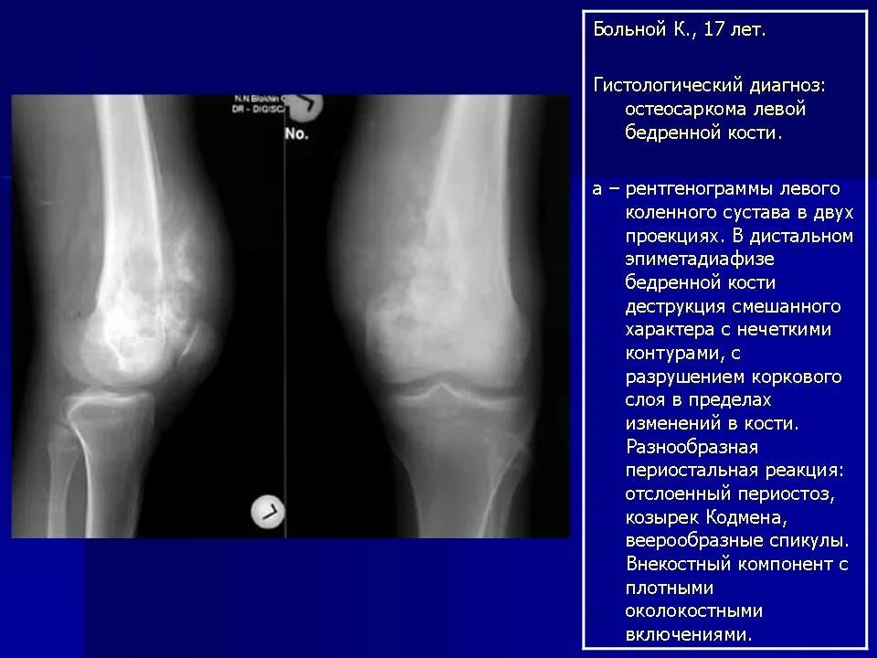 Диагноз саркома. Периостальная саркома большеберцовой кости. Саркома коленного сустава рентген. Остеогенная саркома бедренной кости рентген. Саркома бедренной кости кт.