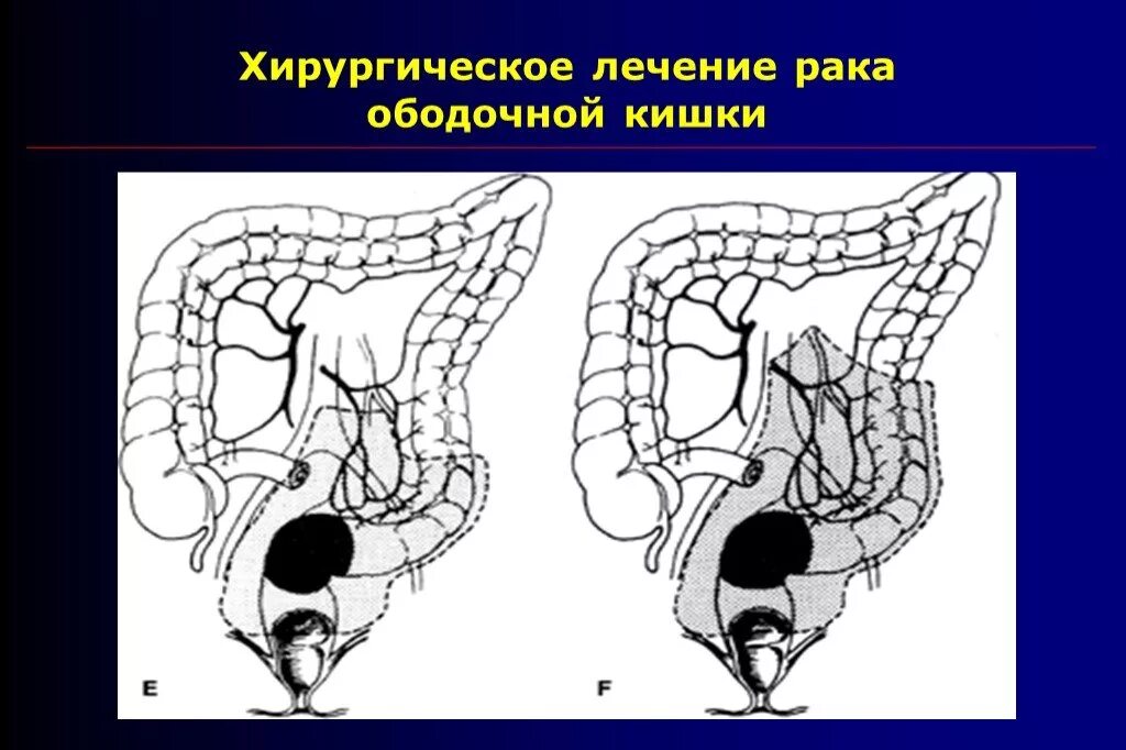 Новообразование ободочной кишки. Злокачественное новообразование восходящей ободочной кишки. Злокачественная опухоль ободочной кишки. Ободочная кишка онкология. Рецидив кишечника