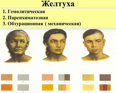 Желтуха виды