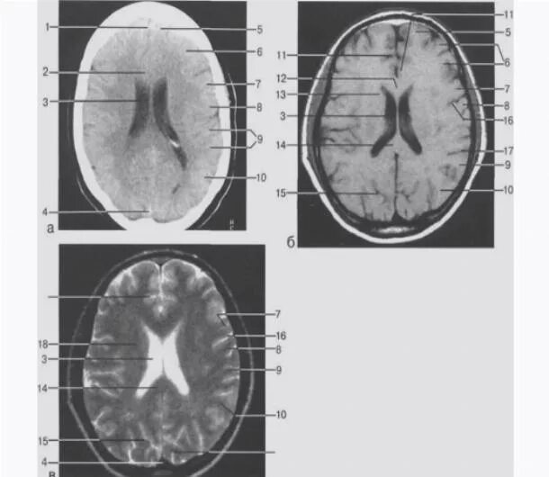 Желудочки головного мозга кт анатомия. Расширение бокового желудочка головного мозга на кт. Боковые желудочки анатомия кт. Расширение боковых желудочков головного мозга мрт. Расширение рогов боковых желудочков