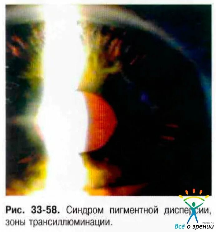 Дисперсия синдром. Веретено крукенберга на роговице. синдром пигментной дисперсии. трансиллюминация радужки. синдром пигментной дисперсии глаза.