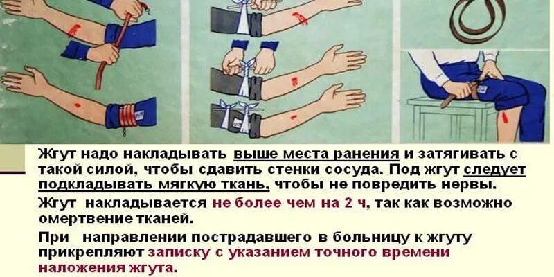 Жгут можно накладывать при кровотечении. Схема наложения жгута при артериальном кровотечении. Жгут для остановки артериального кровотечения. Наложение жгута при артериальном кровотечении летом и зимой. Максимальный срок жгута при артериальном кровотечении.