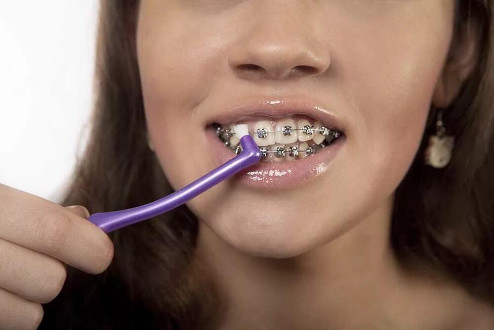 Можно ли есть зубы. Ершики для брекетов. Как чистить зубы с брекетами. Правильная чистка зубов с брекетами.