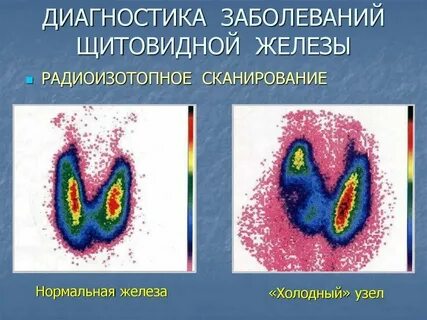 Стенография щитовидной железы