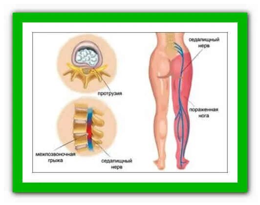 Укол в ягодицу попали в нерв симптомы