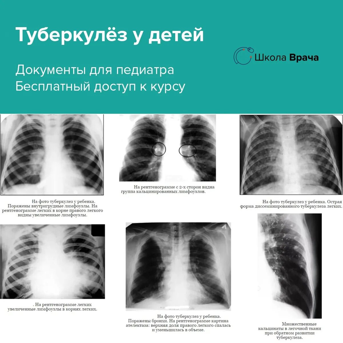 Как определить больные легкие. Туберкулез легких на рентгеновском снимке легких. Рентген снимок диссеминированный туберкулез. Пневмония и туберкулёз на снимке рентгена. Первичный туберкулез синдром рентгенография.