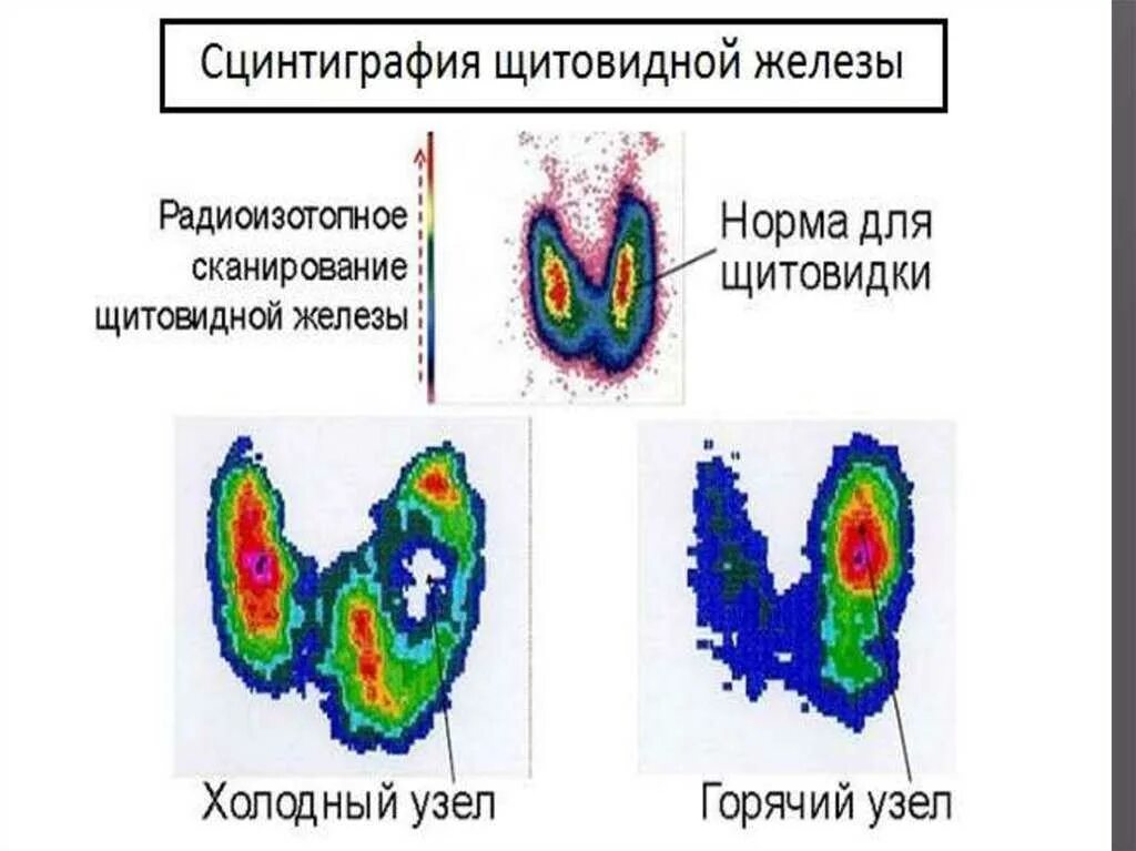 Сцинтиграфия щитовидной железы. Узи исследование щитовидной железы. Ультразвуковое обследование щитовидной железы. Паращитовидные железы на кт анатомия. Продукты питания полезные для сердца и сосудов.