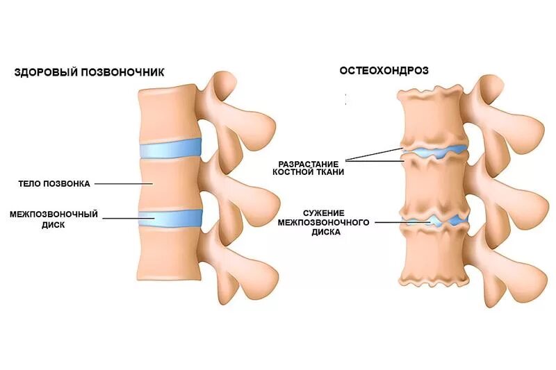 Что такое остеохондроз. Деформирующий спондилез l2 l5. Деформация межпозвоночных дисков. Межпозвонковый остеохондроз. Полисегментарный остеохондроз.