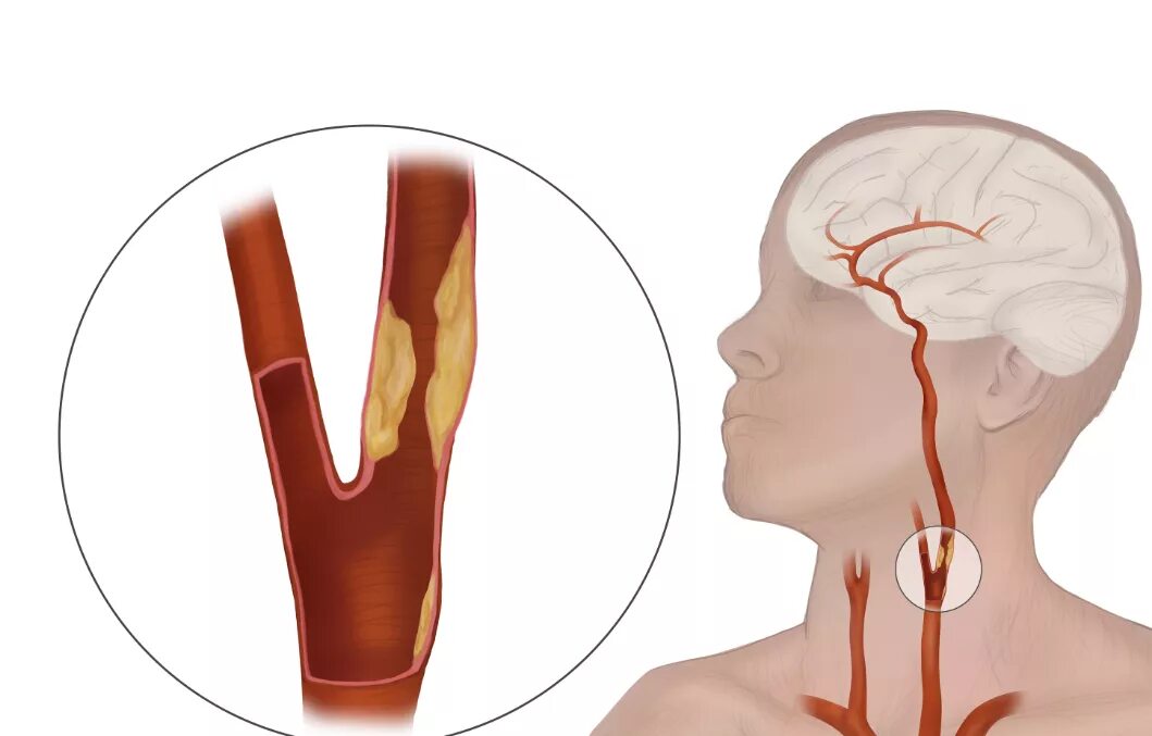 Атеросклероз артерия брахиоцефальных артерий. Каротидная эндартерэктомия. Сосудов атеросклероз сосудов шеи. Каротидная эндартерэктомия сонной артерии. Сужение сосудов симптомы лечение
