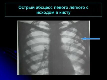 Полоски на легких