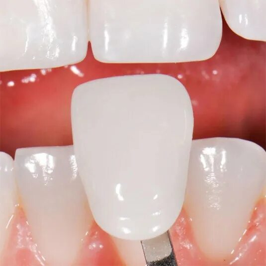 Винир прямой композитный. Фотокомпозитные виниры. винирование композитом.