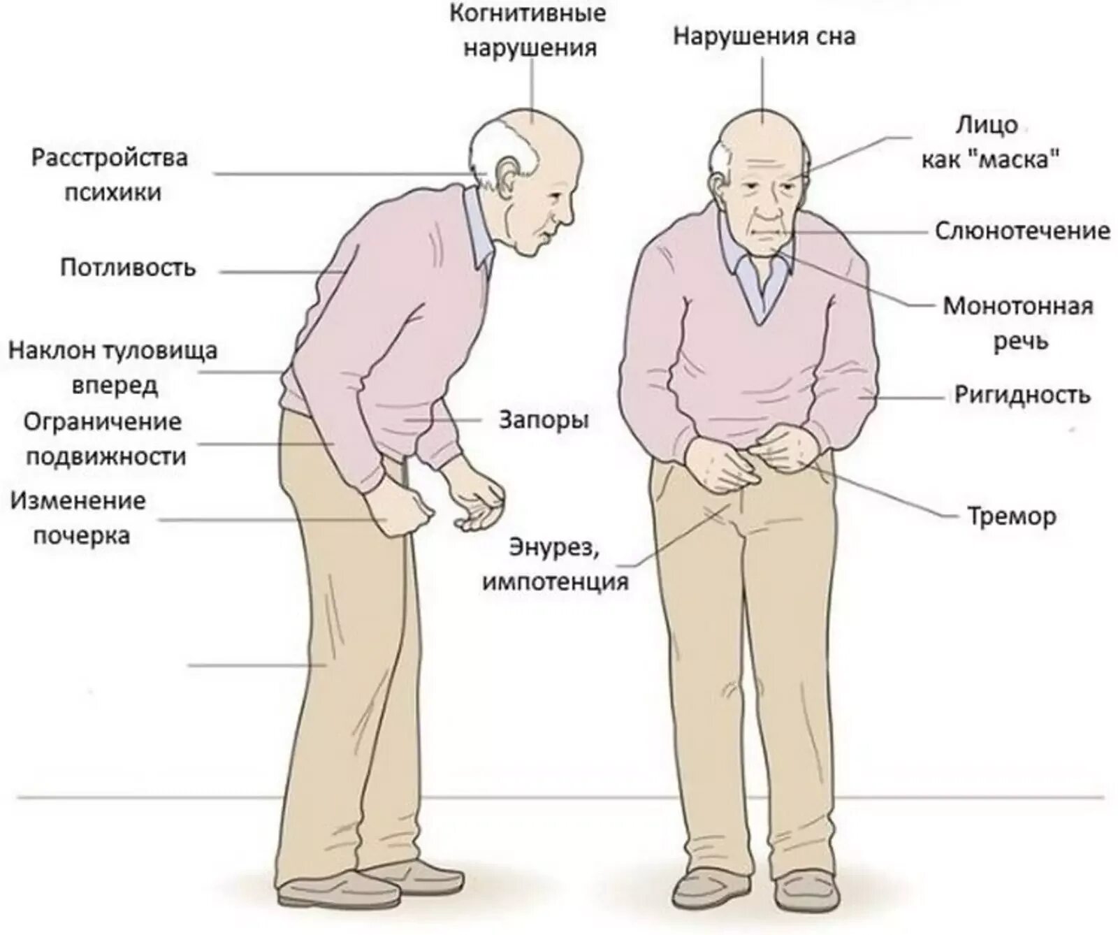 Синдром паркинсонизма симптомы. Клинические синдромы при болезни Паркинсона. Болезнь Паркинсона симптомы и признаки у пожилых. Паркинсон проявления.
