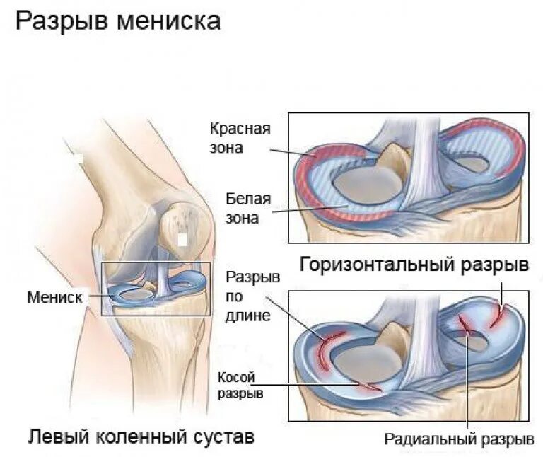 Сильные боли при разгибании колена. Мениски коленного сустава анатомия разрыв. Мениски разрывы мениска коленного сустава. Горизонтальный разрыв медиального мениска. Повреждения внутреннего мениска левого сустава.