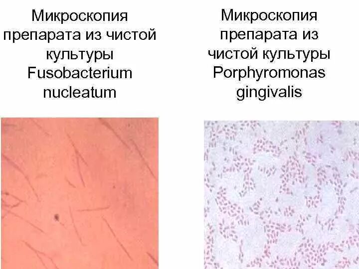 Fusobacterium spp. Фузобактерии симптомы. фузобактерии (род fusobacterium). фузобактерии микроскопия. fusobacterium spp микроскопия.