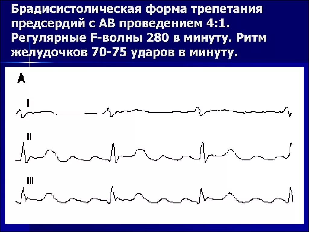 Фибрилляция предсердий нормосистолическая форма на ЭКГ. Фибрилляция предсердий брадисистолическая форма на ЭКГ. Трепетание предсердий тахисистолическая форма на ЭКГ. Ритм трепетания предсердий 1:1. Формы трепетания предсердий