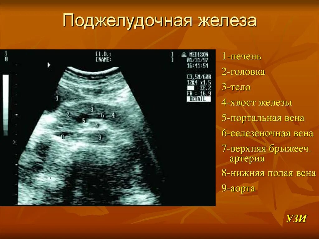 Головка поджелудочной железы на УЗИ. Хвост поджелудочной железы на УЗИ. Опухоль головки поджелудочной железы на УЗИ.