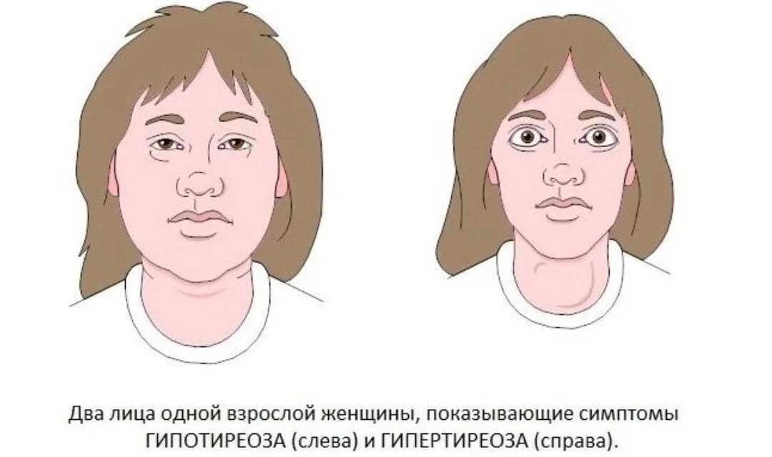 Гипотиреоз и гипертиреоз в чем разница. Различие гипотиреоза и гипертиреоза. Внешность людей с гипотиреозом. Гипотиреоз и гипертиреоз в чем разница. Щитовидка гипотиреоз и гипертиреоз.