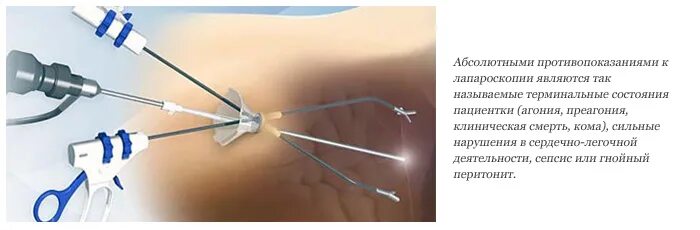 Лапароскопическая операция. Лапароскопия эндоскопия. Лапароскопия миомэктомия. Лапароскопия эндоскопия. Гистероскопия мочевого пузыря.