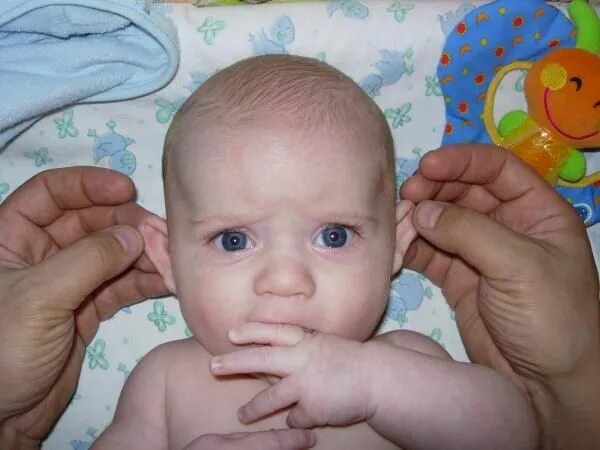 Почему уши разные. Новорожденные с лопоухостью. Лопоухость у детей до года.