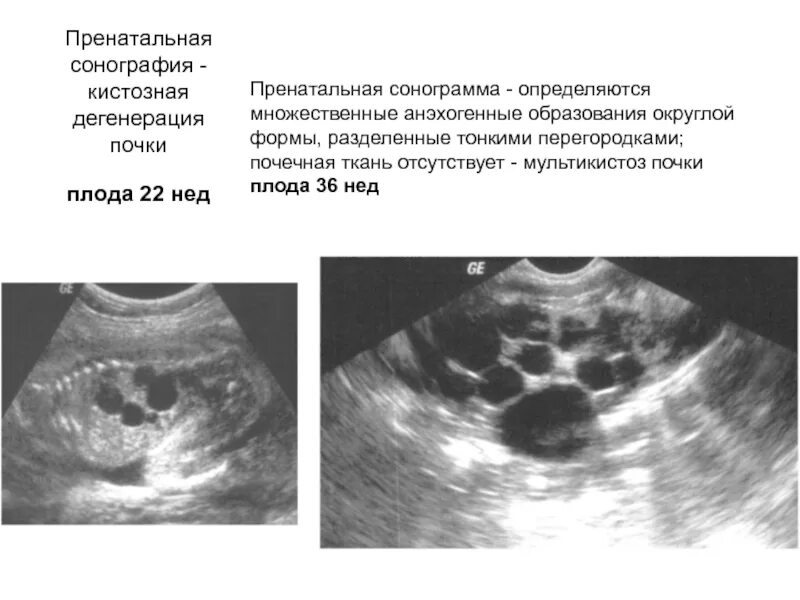 Ультразвуковые исследования(сонография ) почек. Сонограмма почки. Множественные анэхогенные образования. Округлые анэхогенные образования.