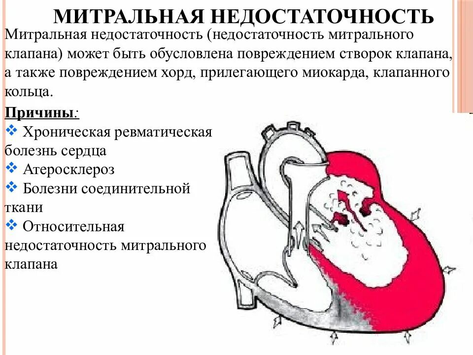 Недостаточность митрального клапана гемодинамика схема. Расстройства гемодинамики при недостаточности митрального клапана. Гемодинамика при митральной недостаточности схема. Изменения сердца и гемодинамики при митральной недостаточности. Сердечная недостаточность митрального клапана