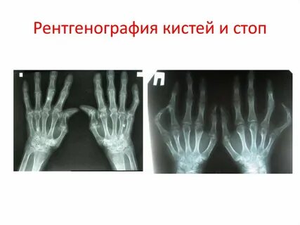 Увеличение кистей и стоп