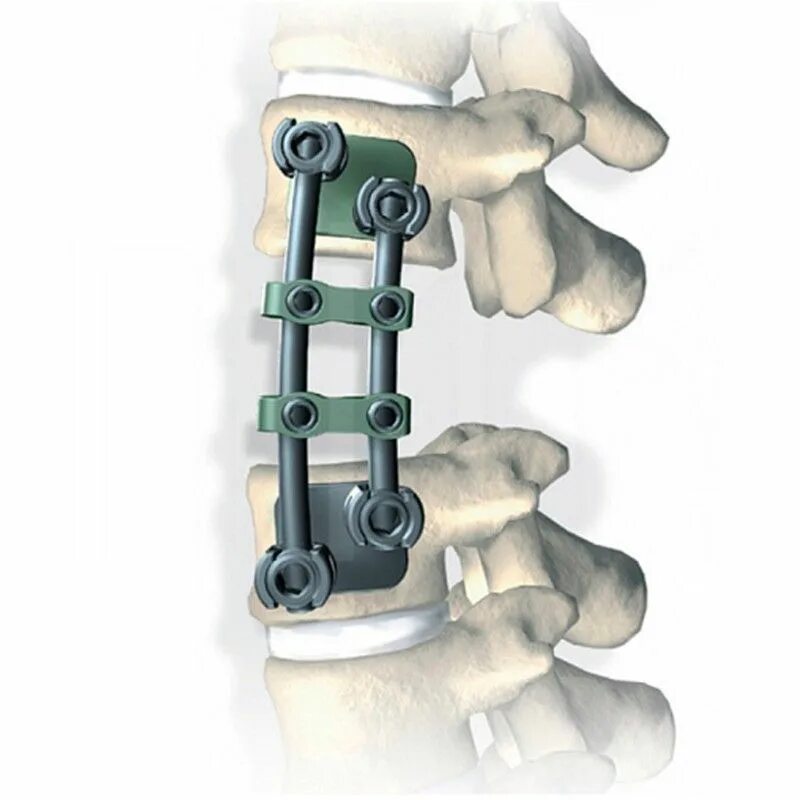 Stryker Xia 3 система транспедикулярной фиксации. Фиксаторы позвоночника Stryker Spine. Кейдж поясничный Xia Stryker. Система фиксации позвоночника имплант Stryker. Операция фиксация позвоночника