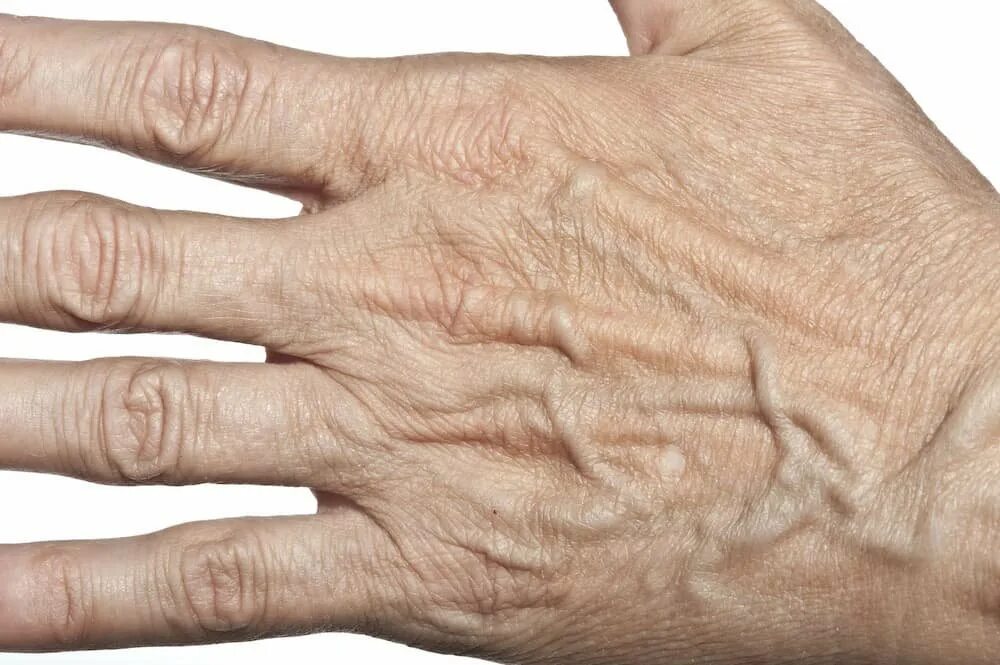 кожа на руках форум. кожа на руках форум. кожа на руках форум. кожа на руках форум. плазмолифтинг кистей рук.