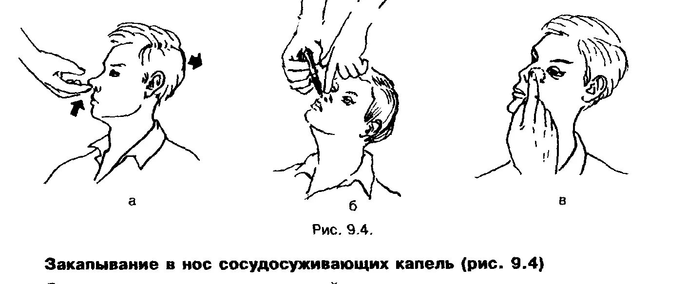 Уход за глазами ушами. Техника закапывания капель в нос. Закапывание сосудосуживающих капель в нос алгоритм. Закапывание масляных капель в нос. Закапывание масляных капель в нос алгоритм.