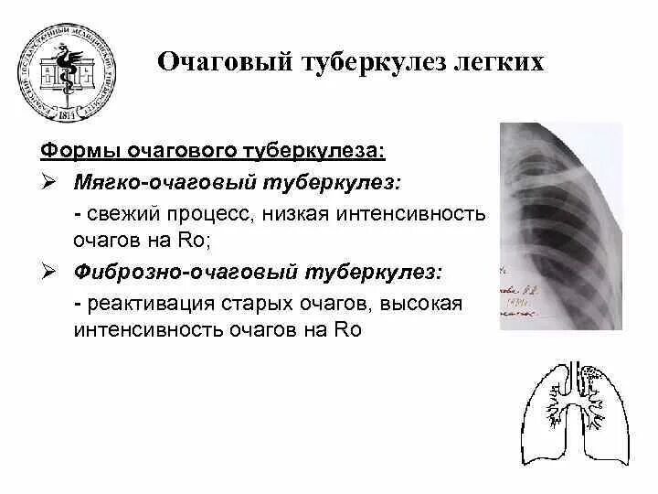 Исход фиброзно-очаговый туберкулеза легких. Формы очагового туберкулеза легких. Очаговый туберкулез верхушки левого легкого схема. Очаговый туберкулез характеризуется.