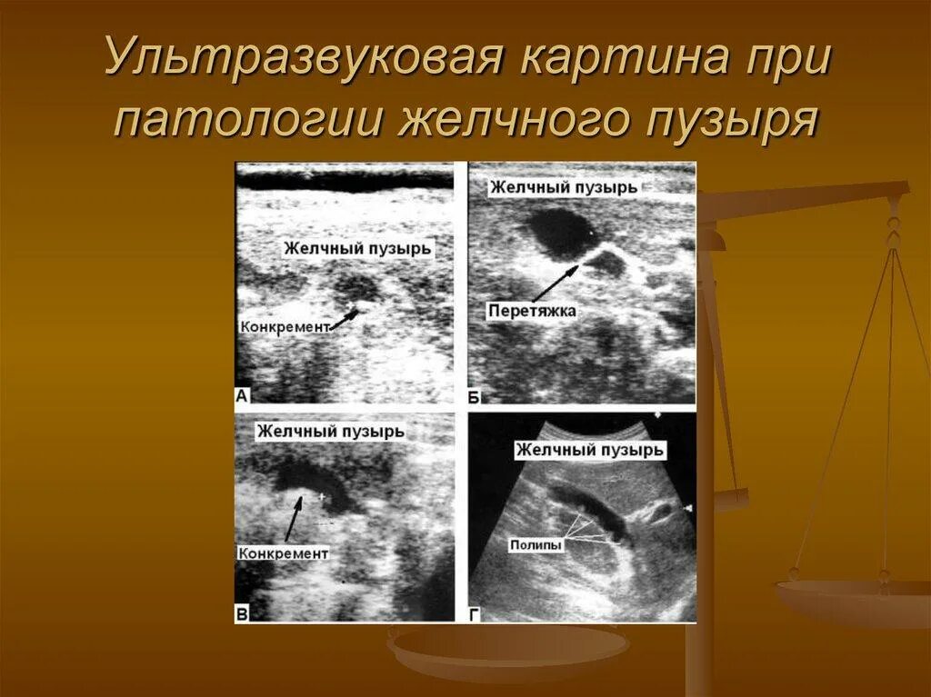 Узи признаки деформации желчного пузыря. Загиб перегиб желчного пузыря. Экскреторная холецистография. Перетяжка желчного пузыря что это. Загиб перетяжка желчного пузыря.