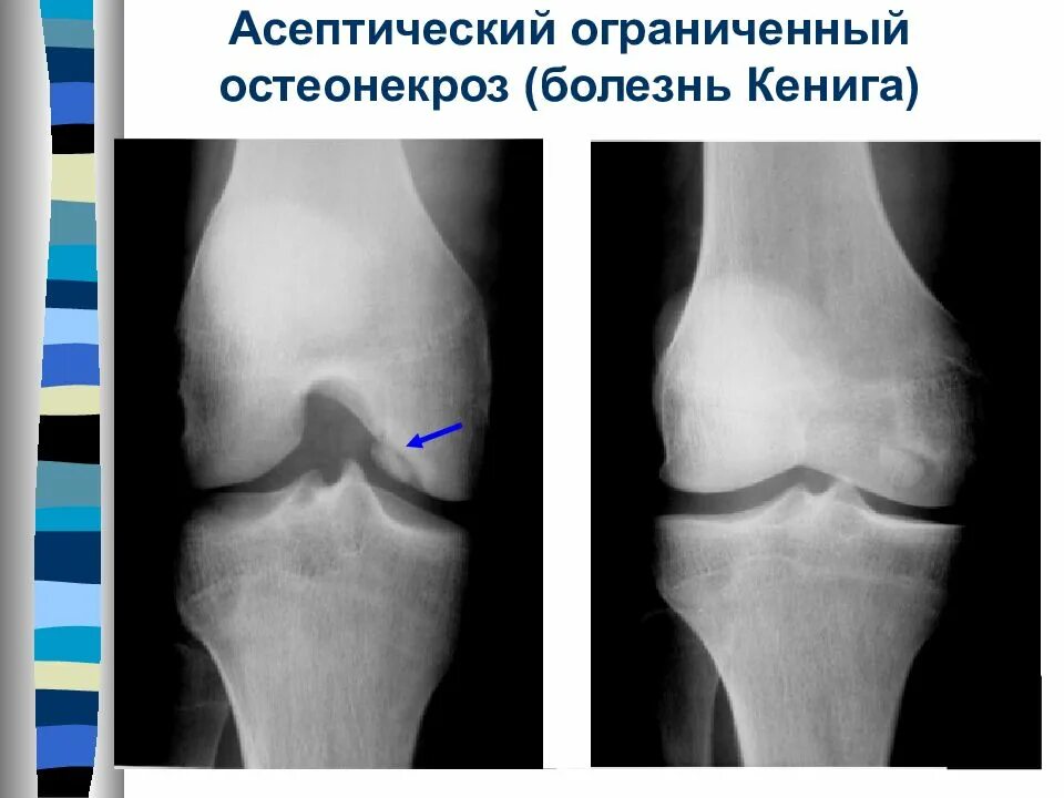 Асептический некроз мыщелка бедренной. Остеохондропатия Кенига. Остеохондрит коленного сустава рентген. Остеонекроз коленного сустава рентген. Асептический некроз мыщелка бедренной кости кт.