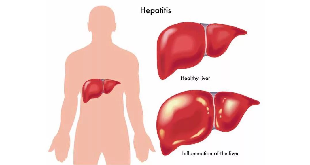 Печень больная гепатитом. Увеличена печень причины и симптомы