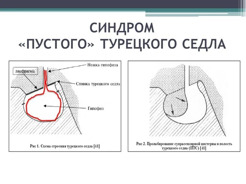 Пустое турецкое седло у мужчины. Симптом пустого турецкого седла. Синдром пустого турецкого седла кт. Синдром пустого турецкого седла клиника. Анатомия турецкого седла и гипофиза.