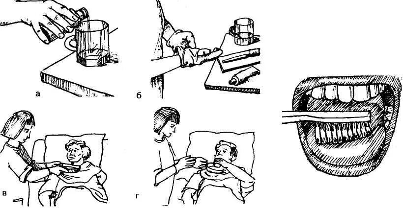 Обработки полости рта тяжелобольным. Обработка полости рта тяжелобольным алгоритм. Уход за ротовой полостью тяжелобольного. Обработка слизистой полости рта алгоритм. Чистка зубов тяжелобольному пациенту алгоритм.