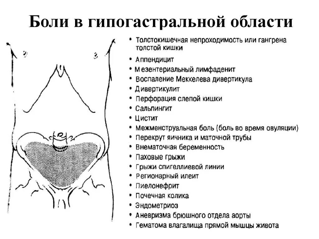 Боли в гипогастральной области. Боль в гипогастральной области живота. Гипаэстеральная область болит. Боль в надлобковой области.