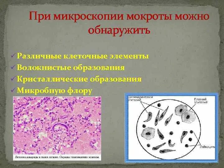 В мокроте можно обнаружить. Клетки при микроскопии мокроты. Микроскопическое исследование нативного препарата мокроты. Мокрота нативный препарат микроскопия. Бронхиальная астма микроскопия мокроты.