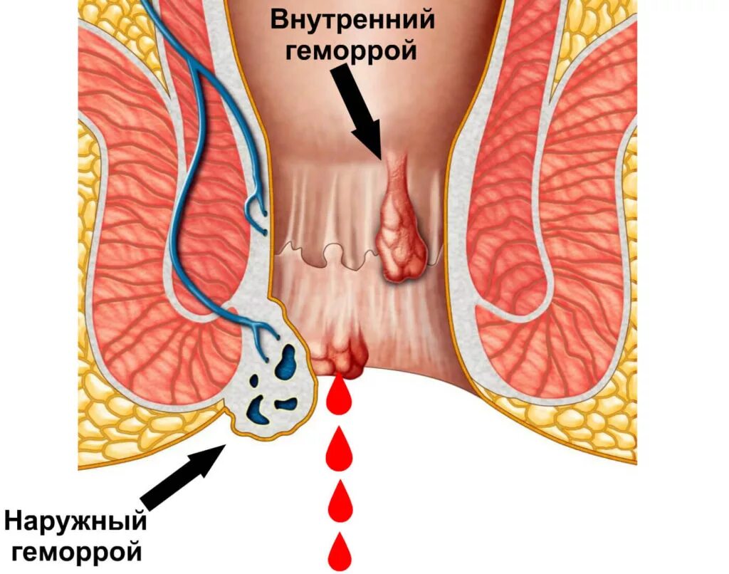 Тромбофлебит вен заднего прохода. Геморрой неприятные ощущения. Кровь из заднего прохода у мужчин