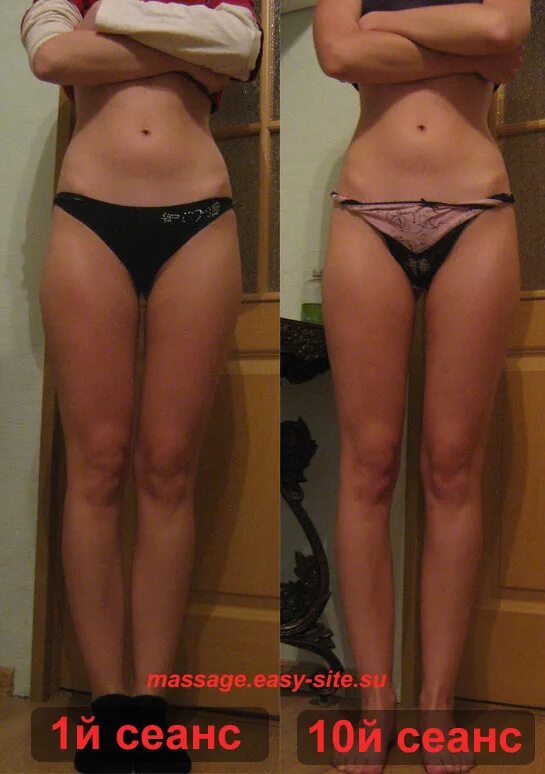 Лимфодренажный массаж до и после. Фигура до и после массажа. Массаж для похудения до и после. Результаты антицеллюлитного массажа. До и после антицеллюлитного массажа.