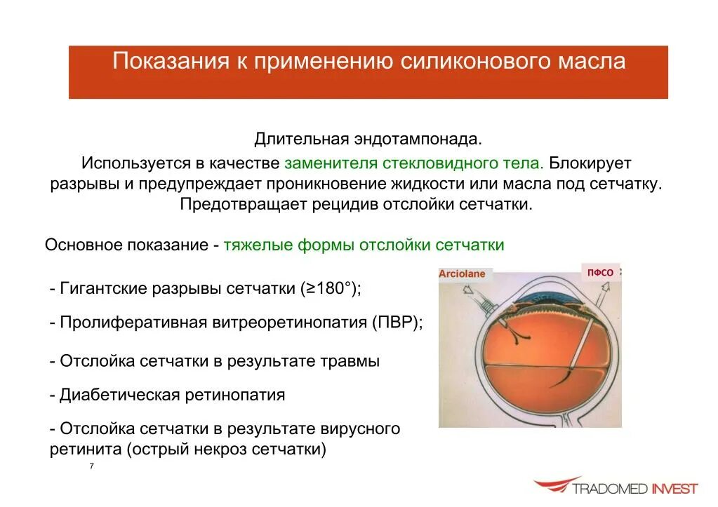 Рецидив отслойки сетчатки. Силиконовое масло под сетчаткой. Силикон при отслойке сетчатки. Силикон в стекловидном теле. Использовать в качестве заменителя