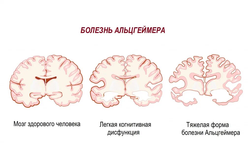Как определить слабоумие