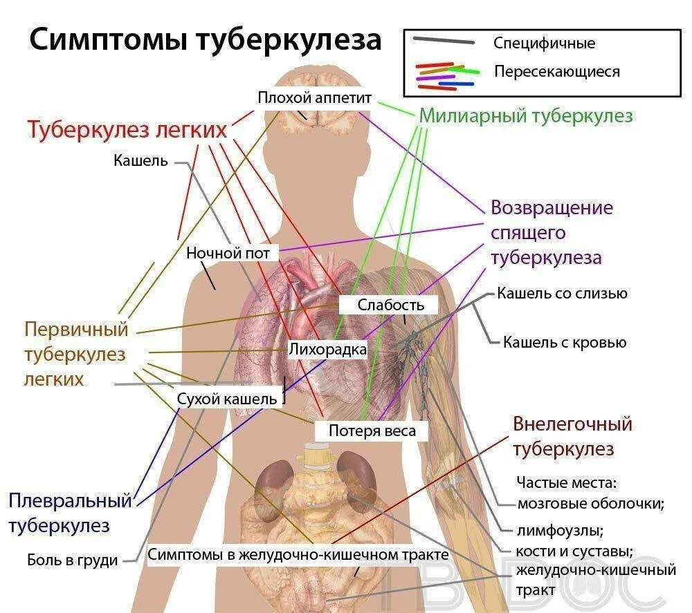 Как определить туберкулез. Симптомитика туберкулез. симптомы проявления туберкулеза.