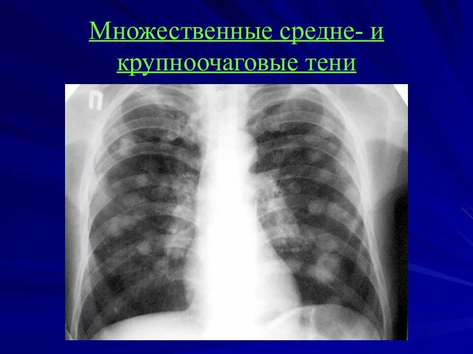 Очаговый туберкулез рентген. Очаговый туберкулез рентген кт. Рентгенодиагностика заболеваний легких. Множественные очаговые тени в легких. Округлое затемнение